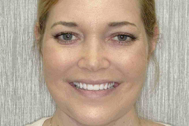 headshot of patient after procedure
