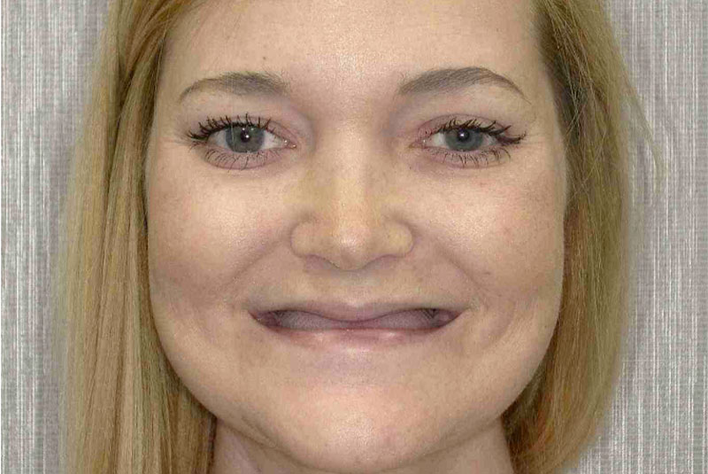 headshot of patient before procedure