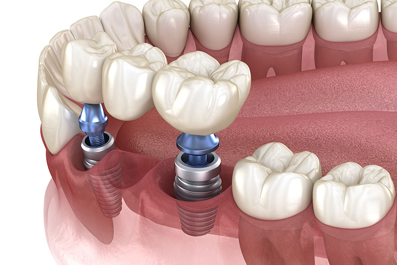 dental implant bridge