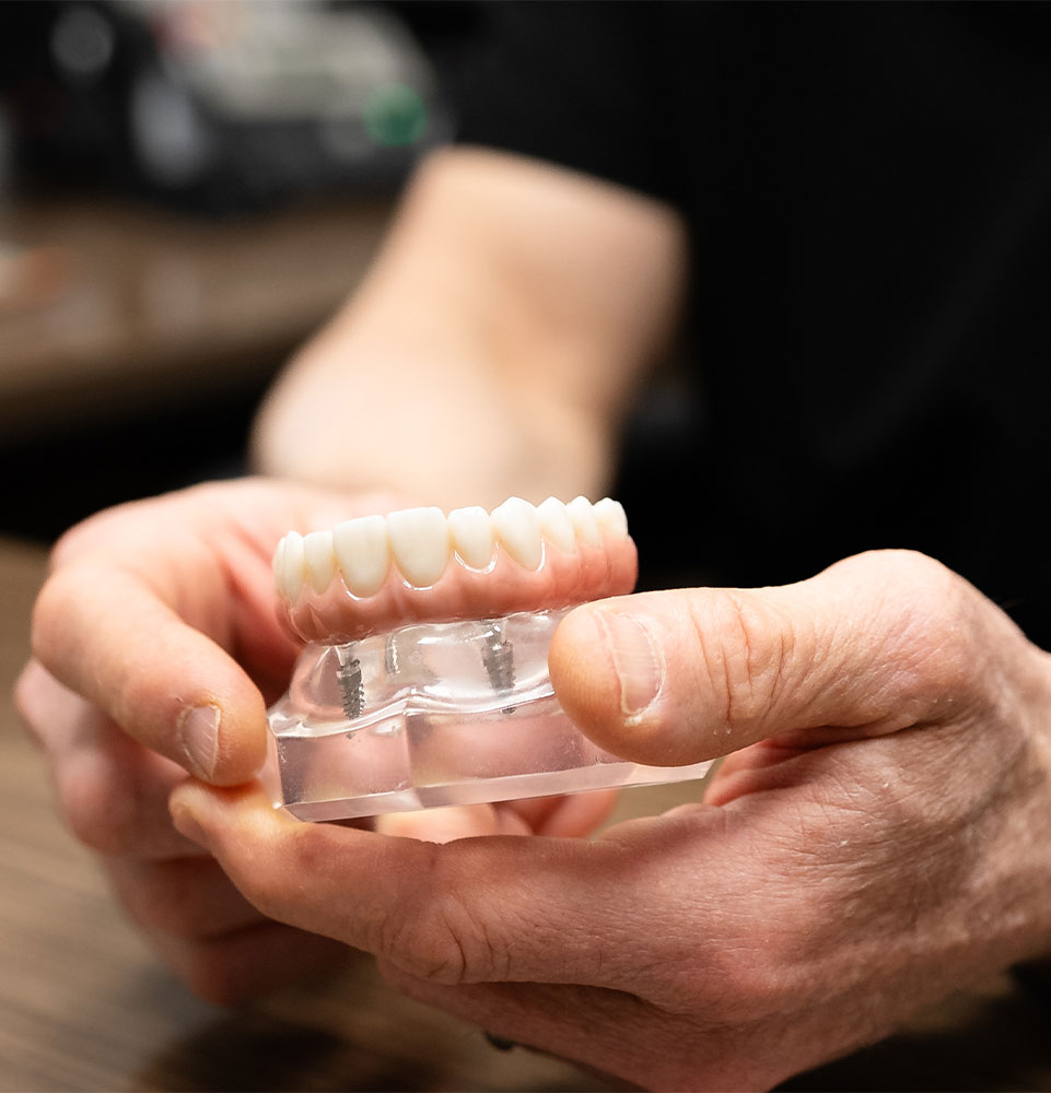 full arch dental implant