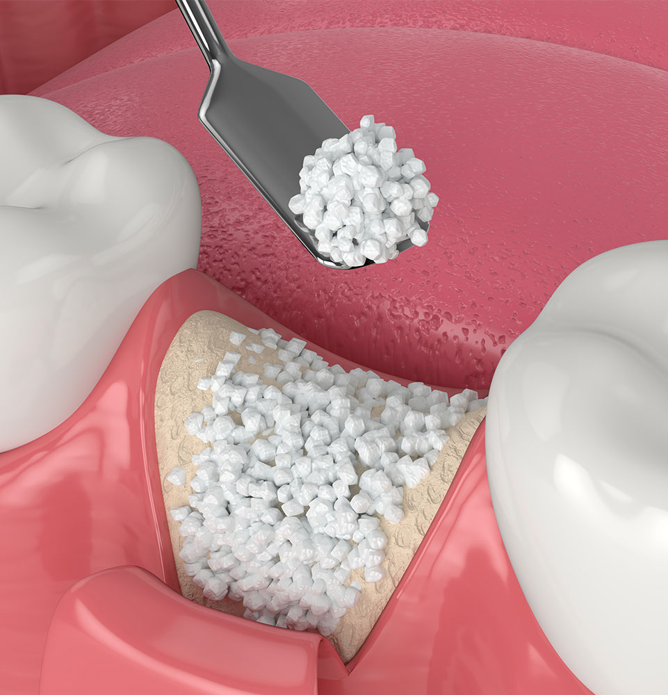 bone grafting