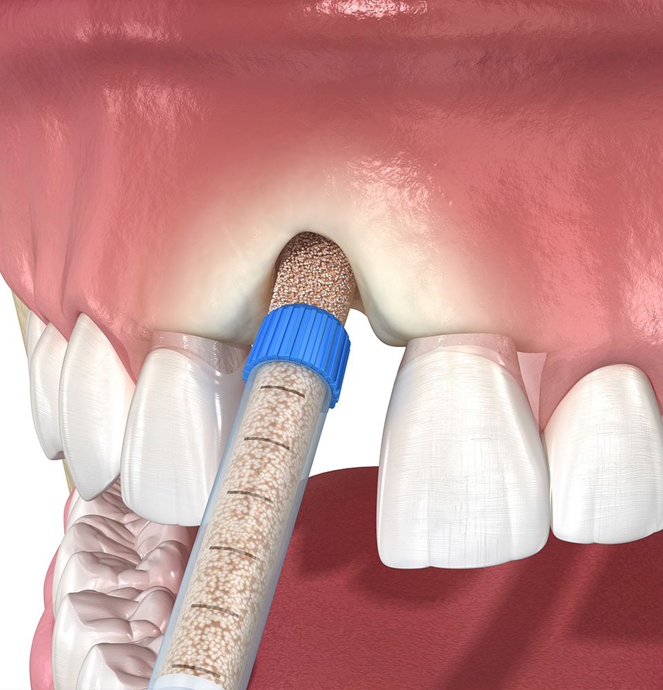 Bone Grafting