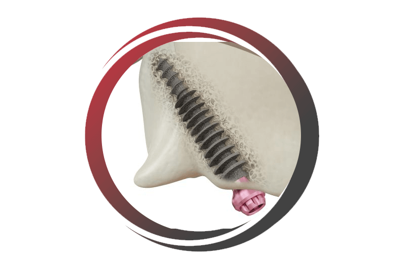 Dental implants