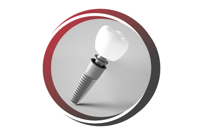 dental implant
