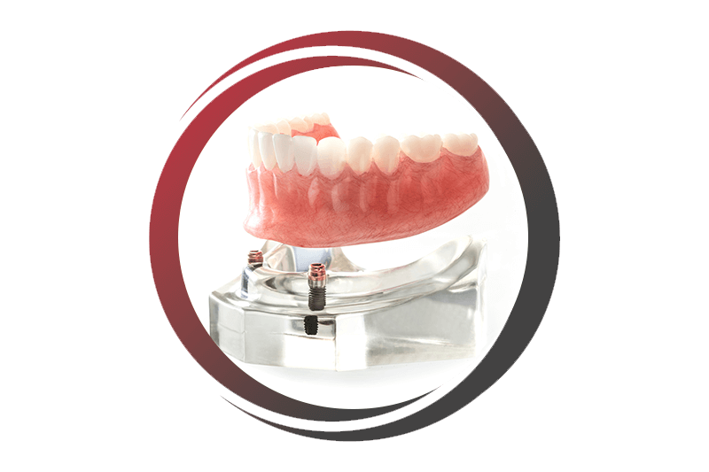 implanted dentures