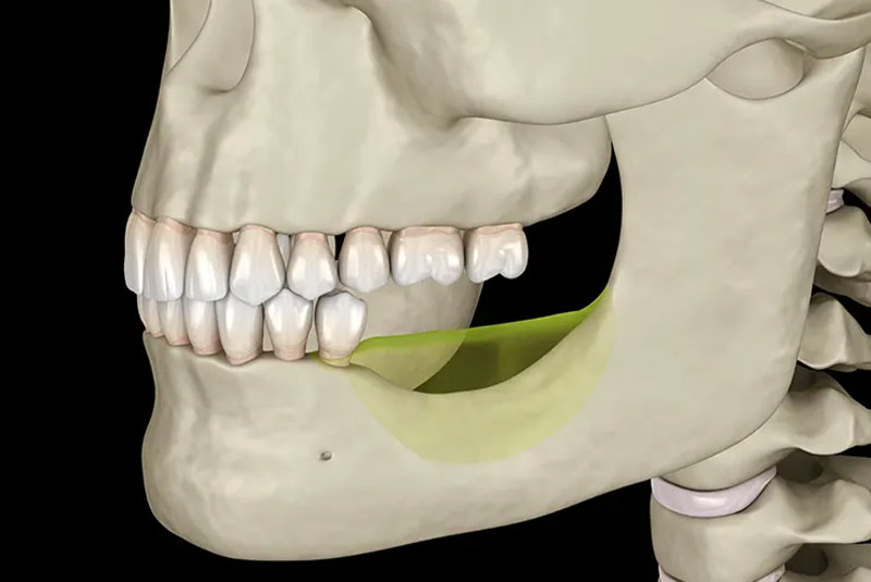 Bone Loss