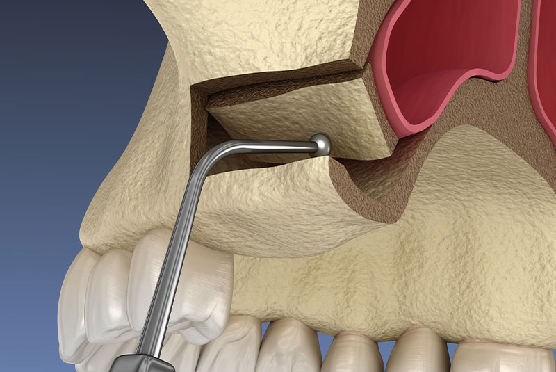Sinus LIft