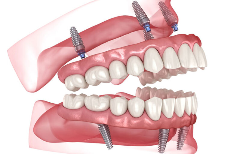 3D rendering of full-arch fixed prosthetics supported by four angled dental implants in both upper and lower jaws, illustrating All-on-4 implant placement technique.