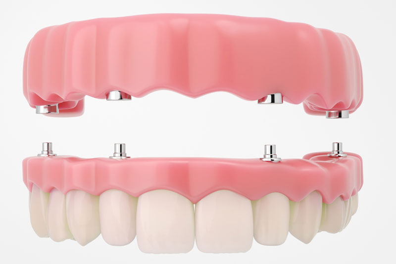 Full-arch implant-supported denture with titanium screws