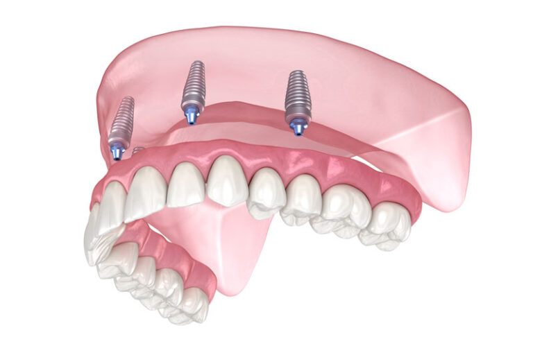 3D digital illustration of a top full arch dental implant restoration showing four dental implants supporting an upper fixed denture.