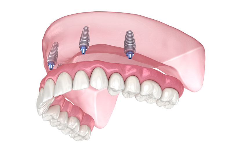 3D digital illustration of a top full arch dental implant restoration showing four dental implants supporting an upper fixed denture.