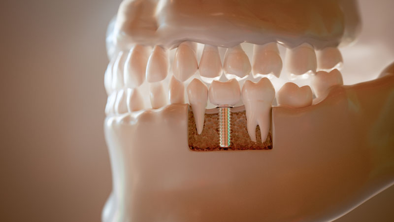 Dental implant, artificial tooth roots into jaw, root canal of dental treatment, gum disease, teeth model for dentist studying about dentistry