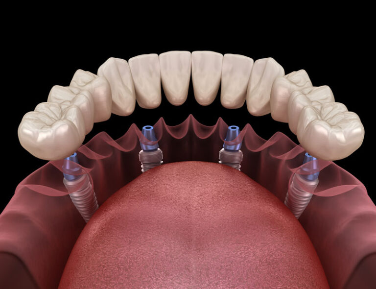 3D rendering of full-arch fixed prosthetics supported by four angled dental implants in both upper and lower jaws, illustrating All-on-4 implant placement technique.