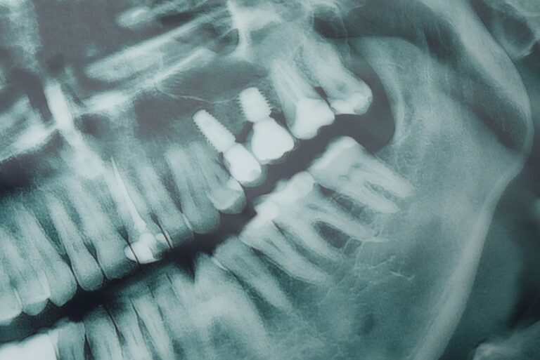 Close up image of a titanium dental implant screw next to a set of false teeth. The background is blurred out. No text on image.