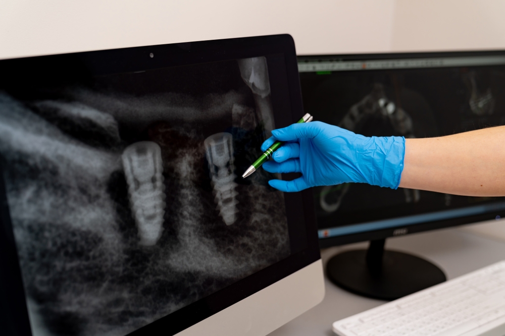 Implant-supported dentures consultation in dental office